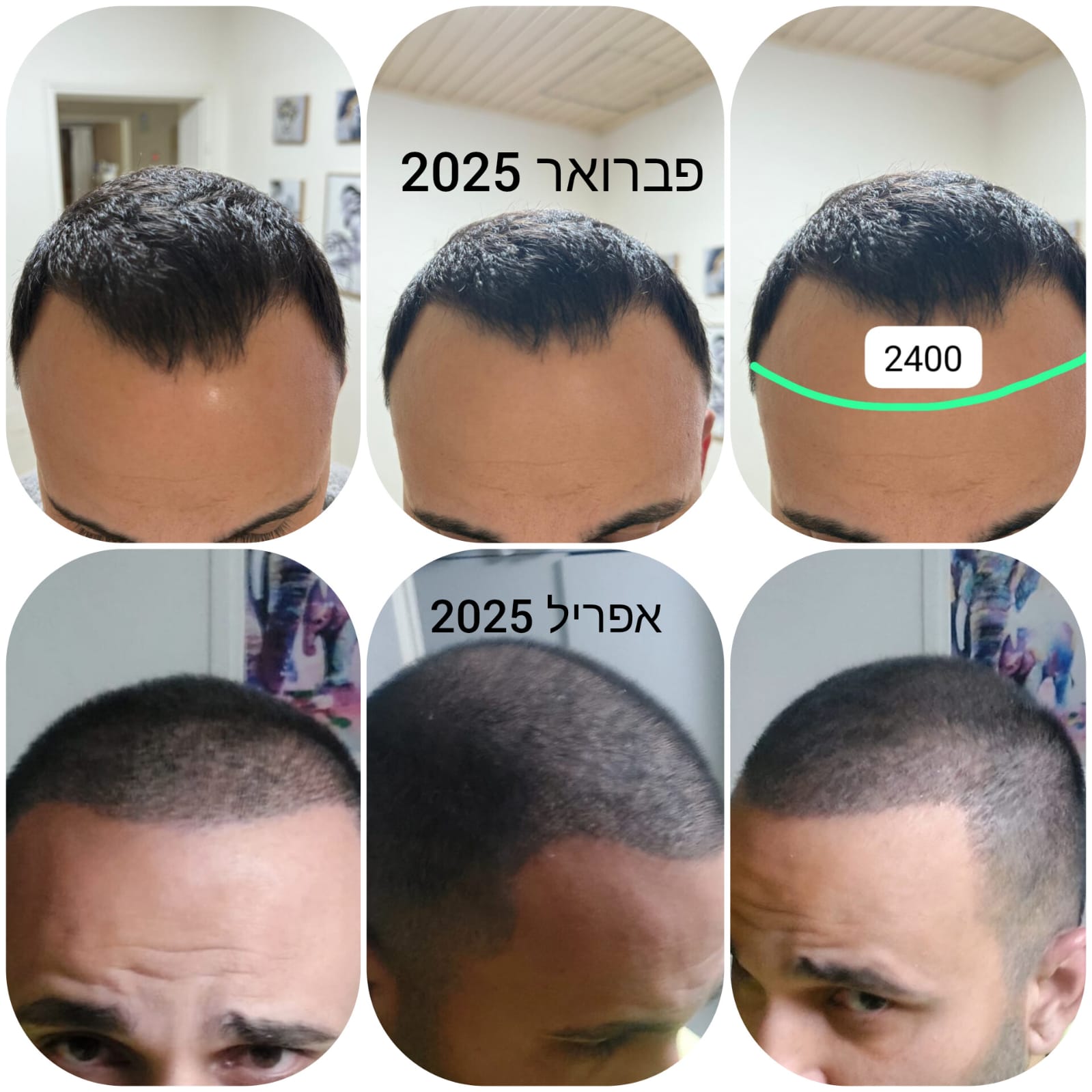 לפני ואחרי · השתלת שיער