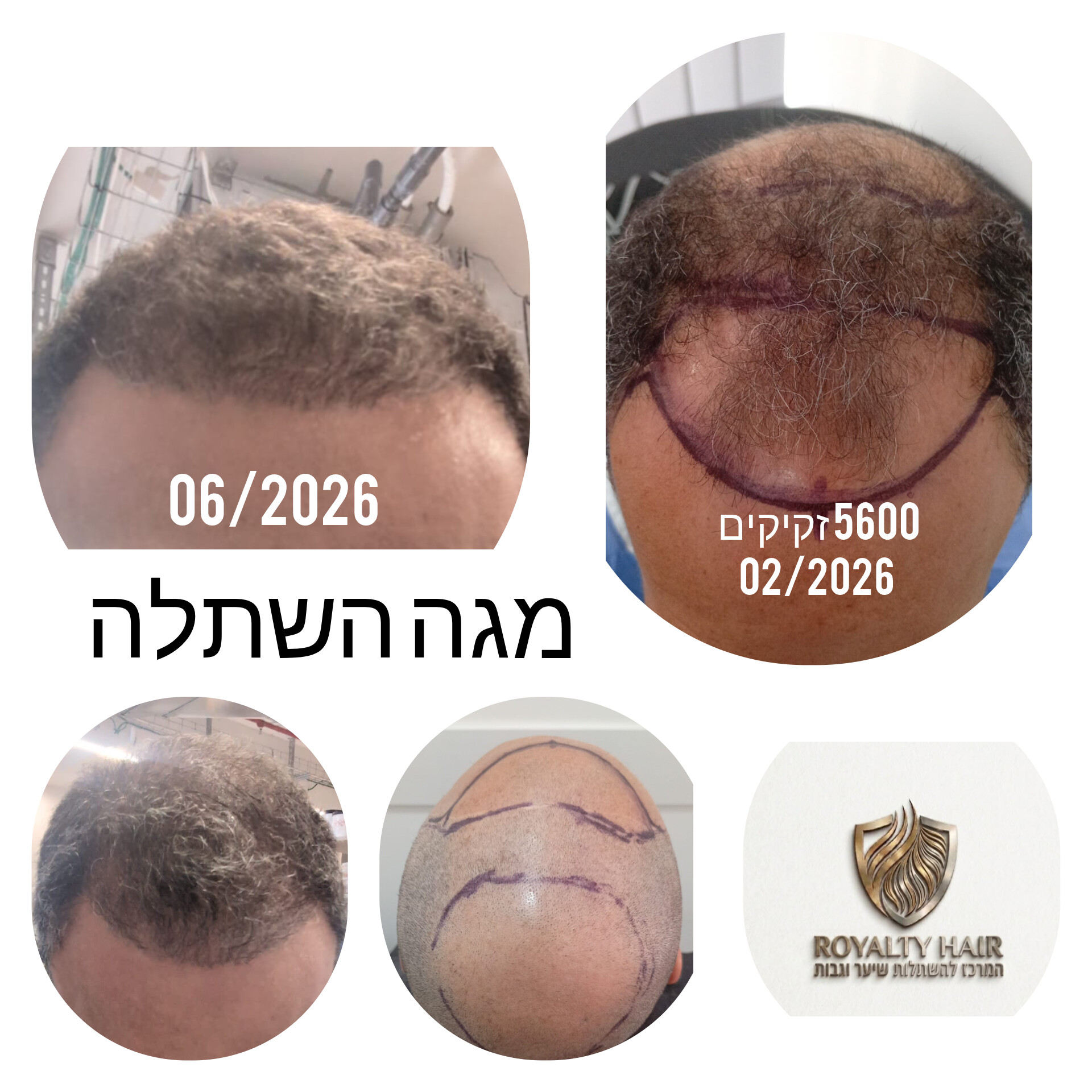 לפני ואחרי · השתלת שיער