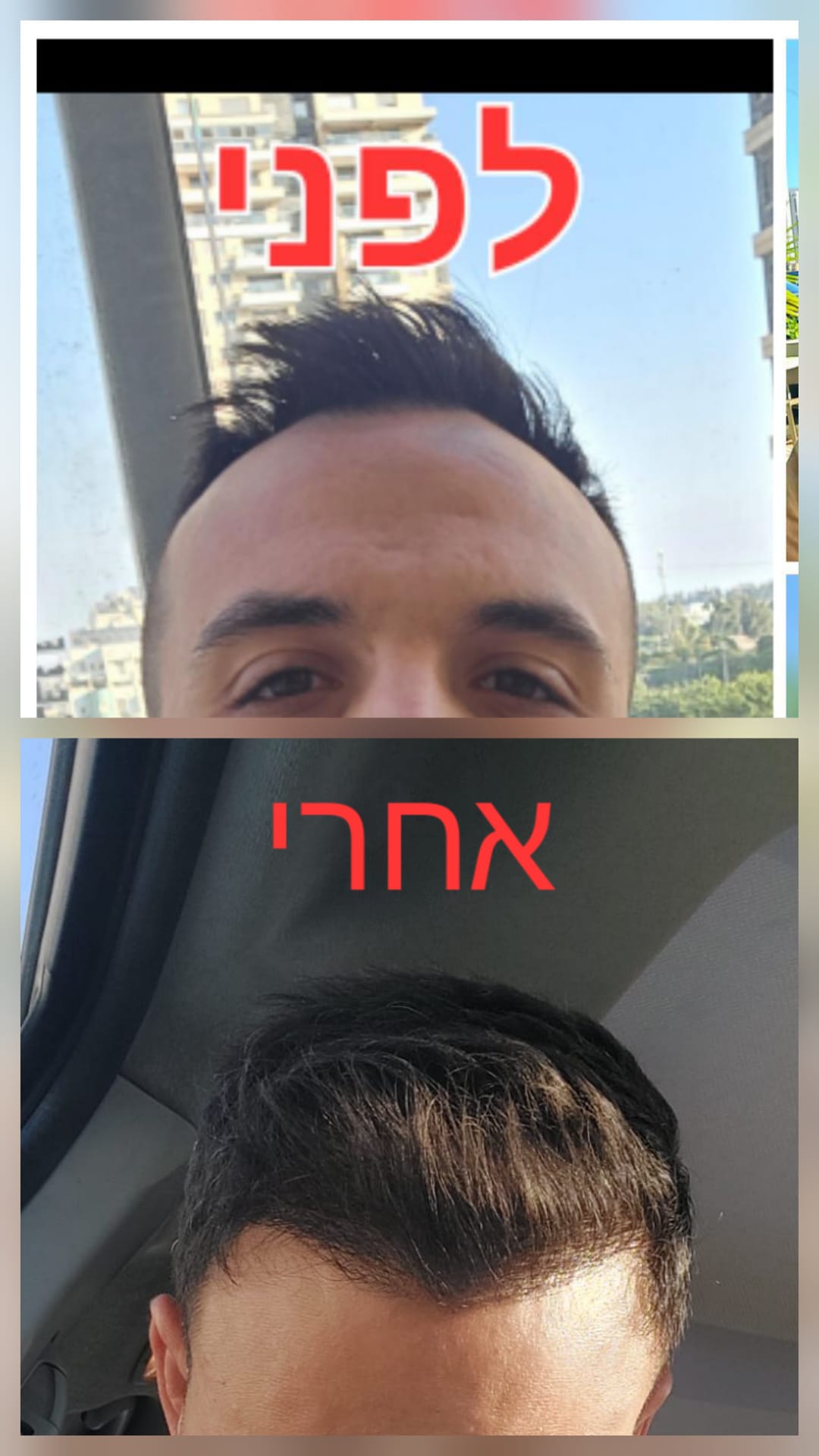 לפני ואחרי · השתלת שיער