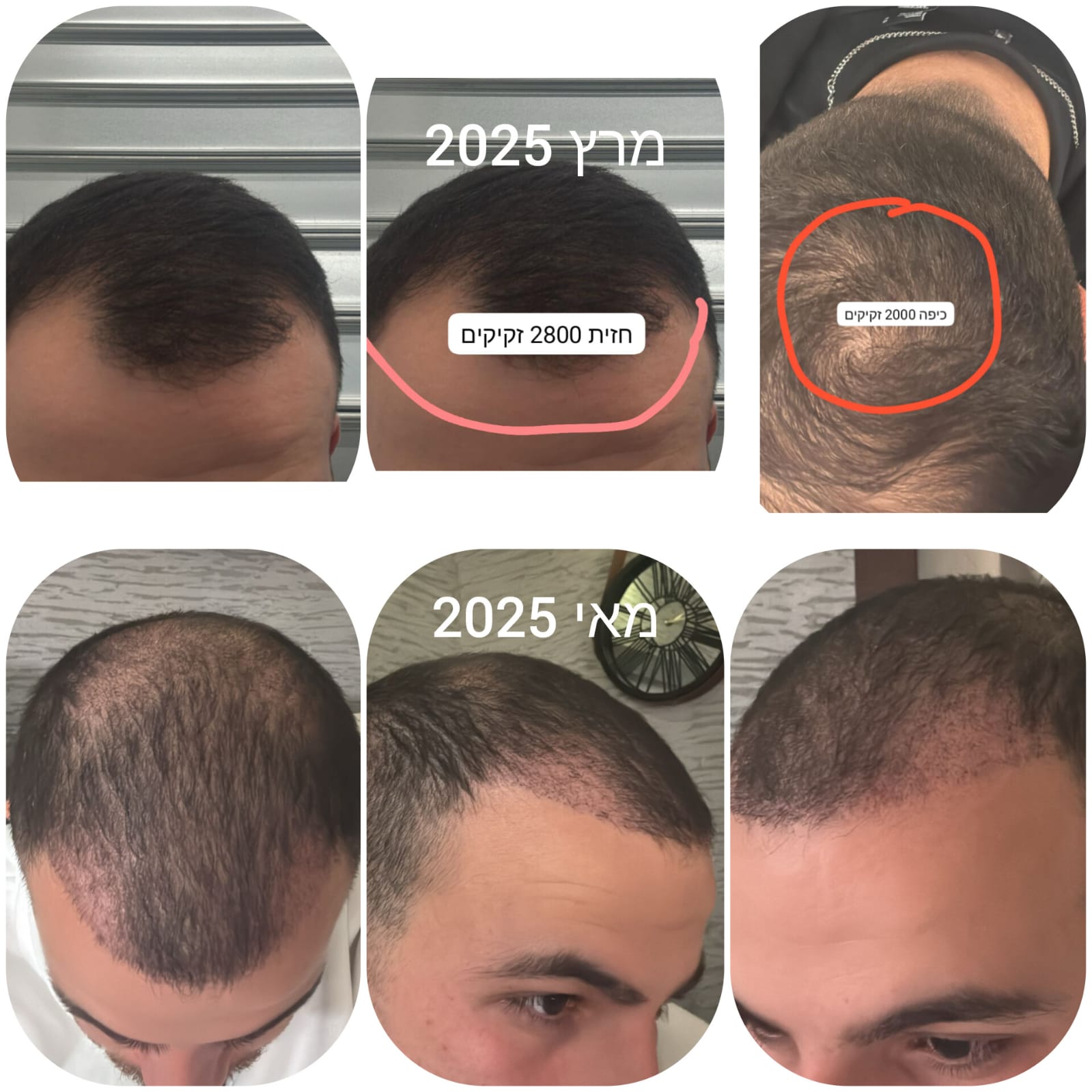 לפני ואחרי · השתלת שיער