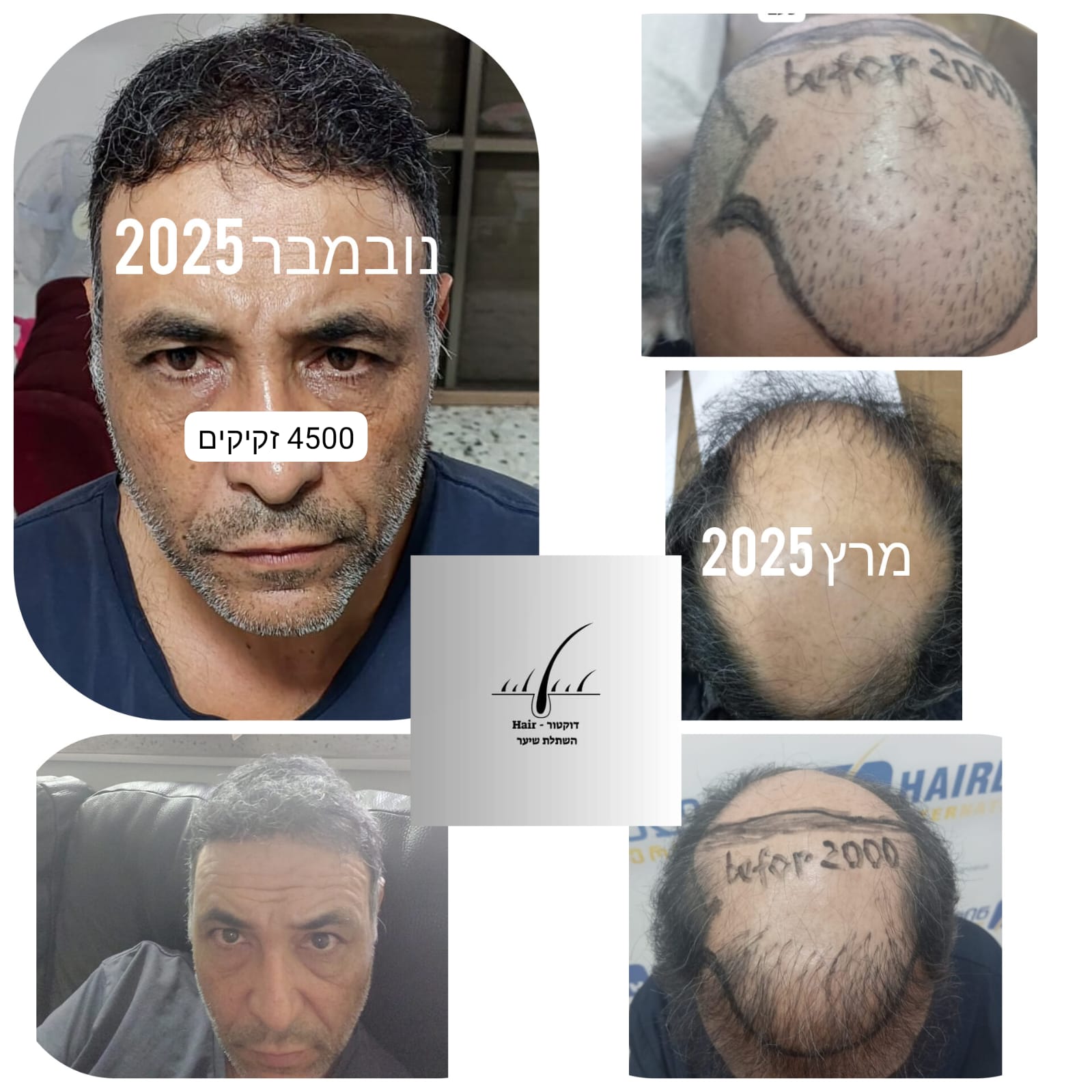 לפני ואחרי · השתלת שיער
