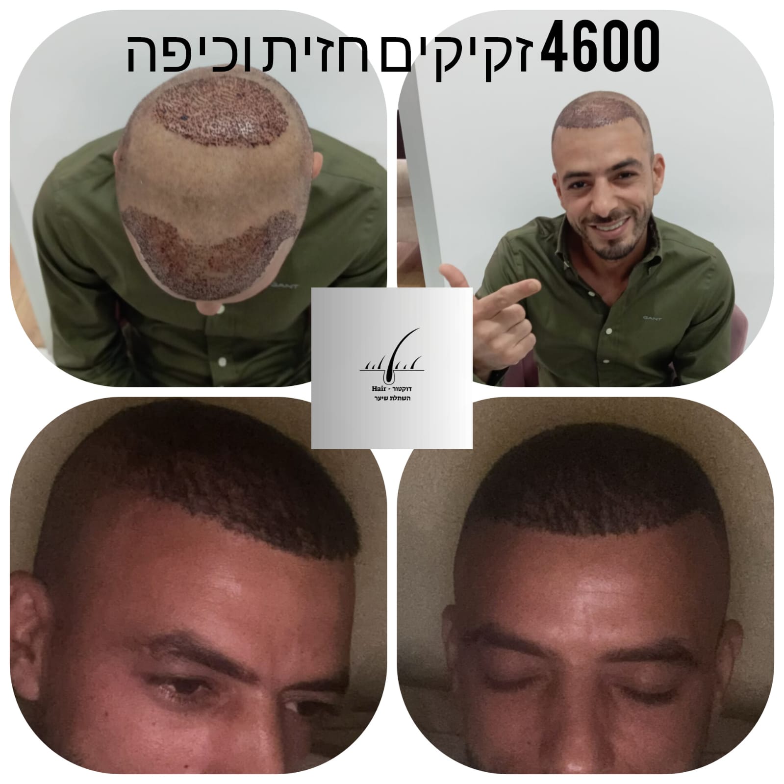 לפני ואחרי · השתלת שיער