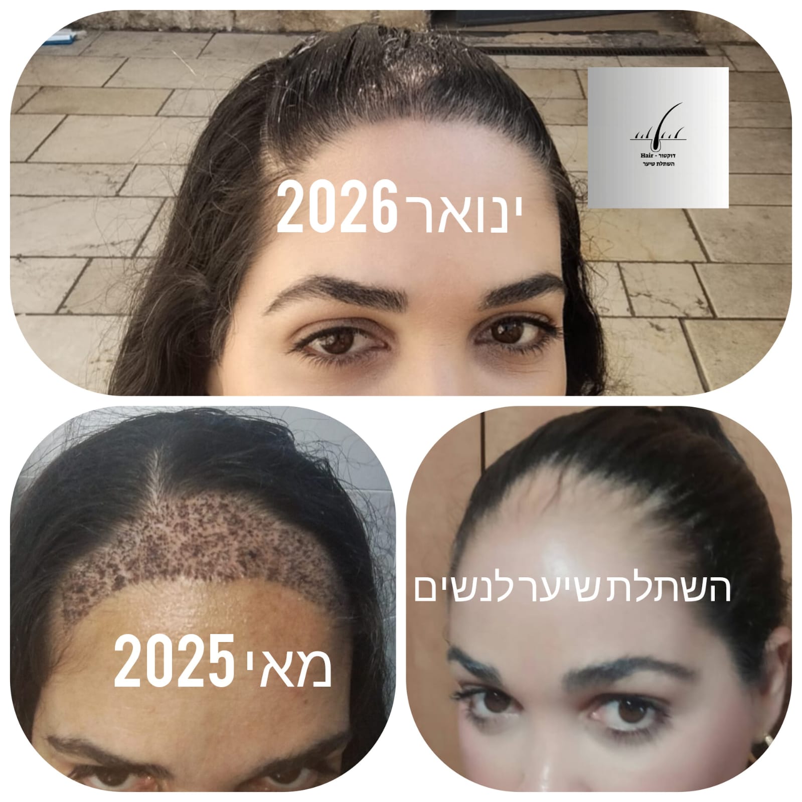 לפני ואחרי · השתלת שיער