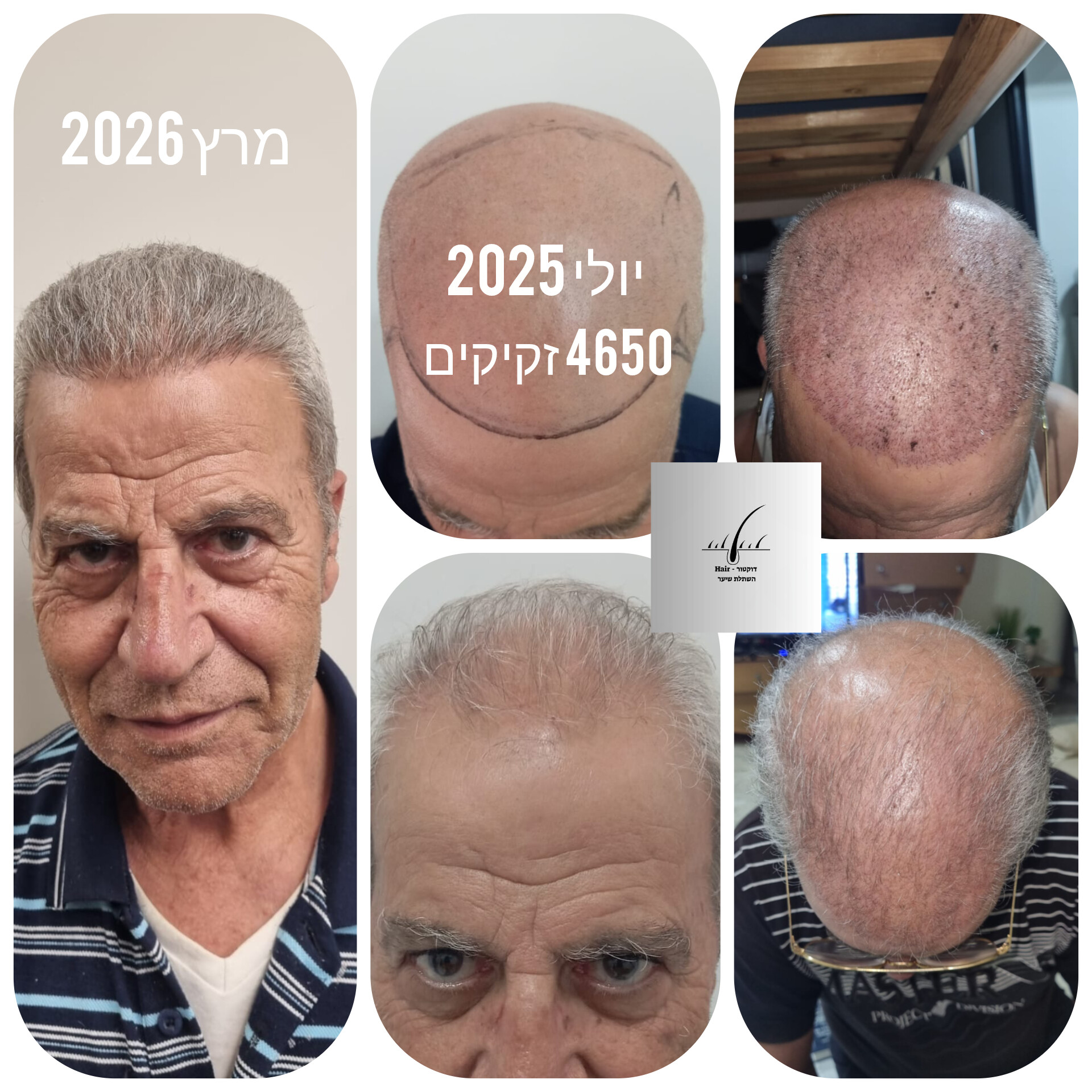 לפני ואחרי · השתלת שיער