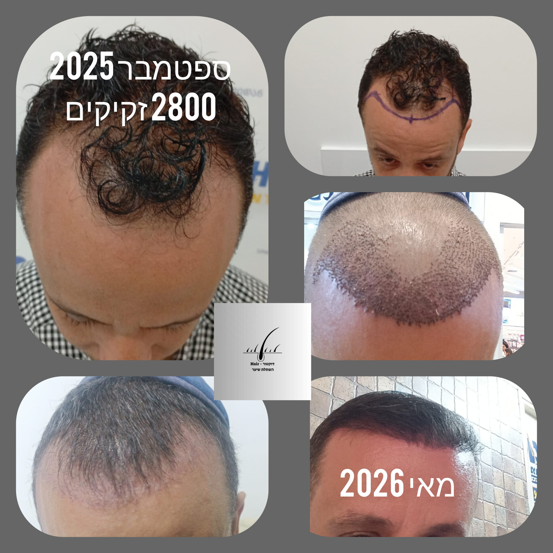 לפני ואחרי · השתלת שיער