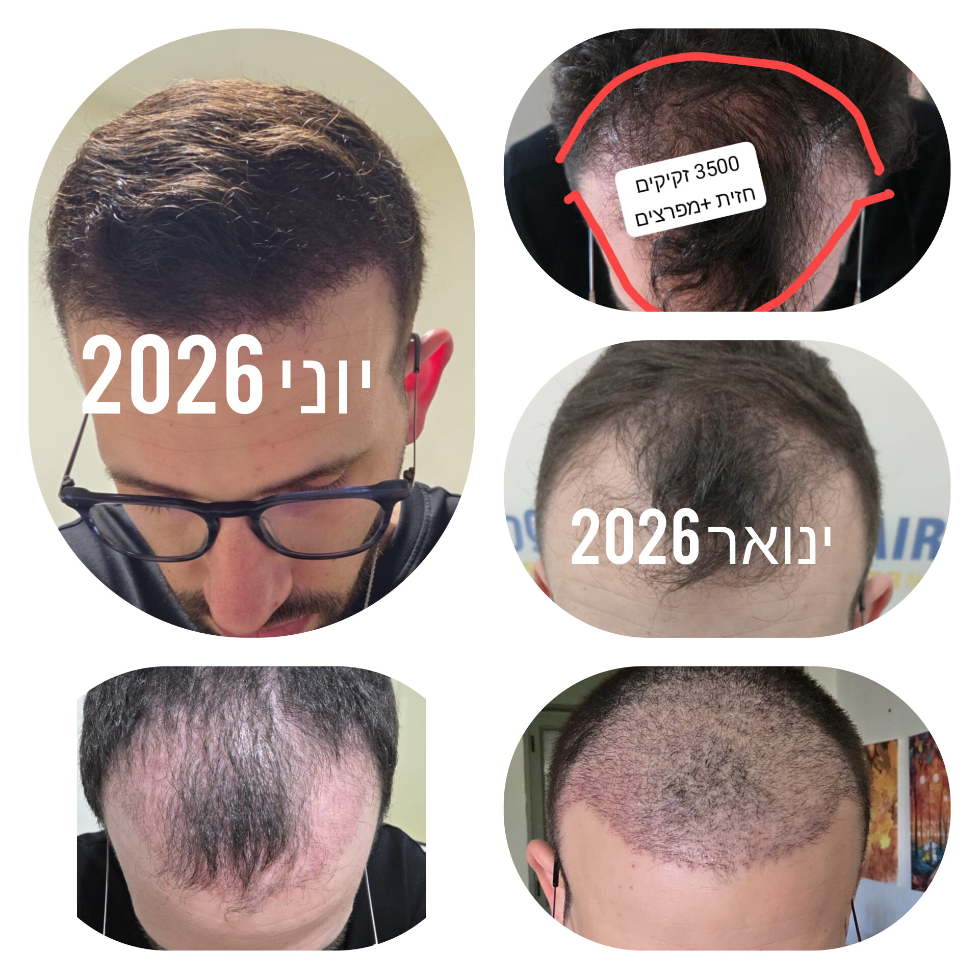 לפני ואחרי · השתלת שיער